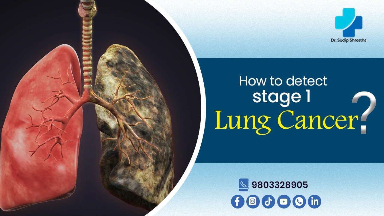 detect stage 1 lung cancer