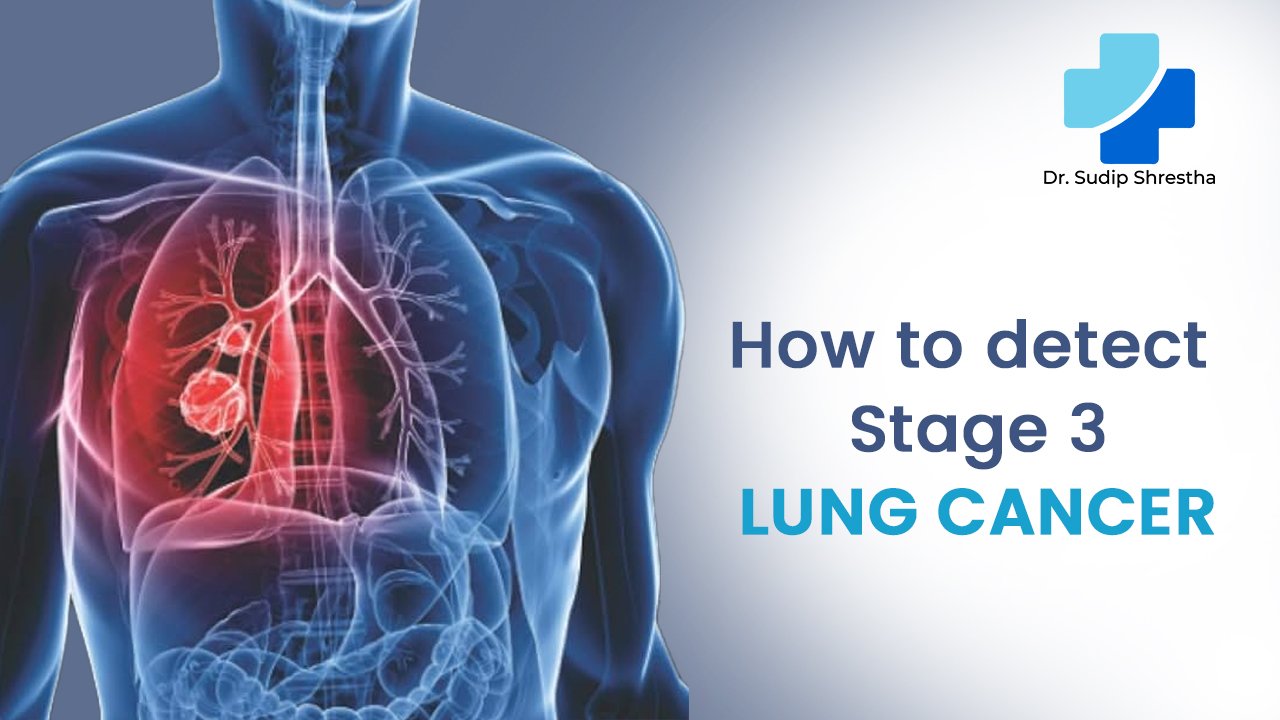 detect stage 3 lung cancer