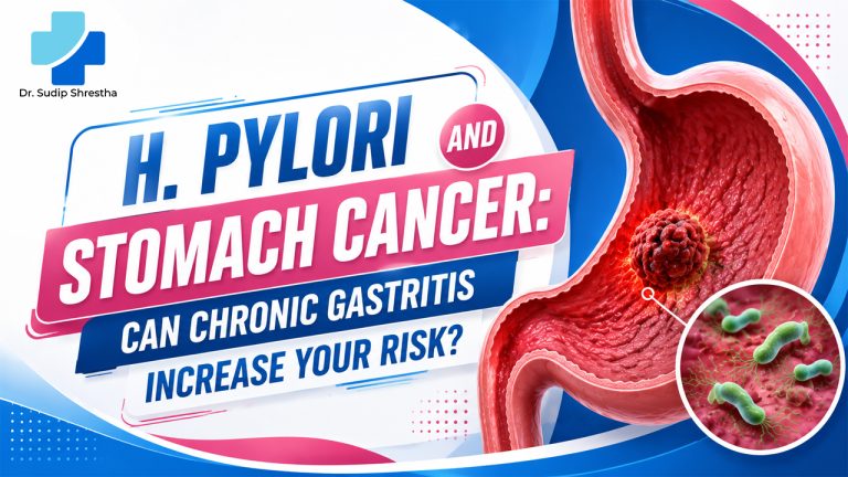 H. pylori and Stomach Cancer: Can Chronic Gastritis Increase Your Risk?